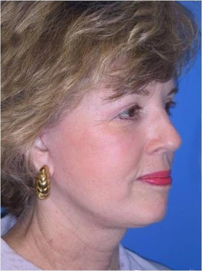 Neck Lift Before & After Gallery - Patient 91474246 - Image 4