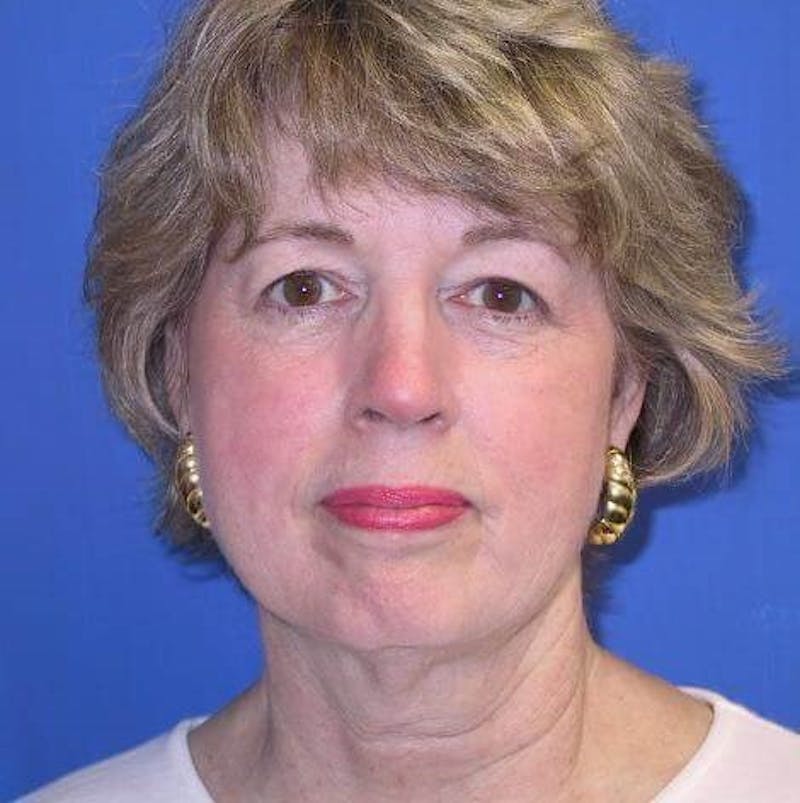 Neck Lift Before & After Gallery - Patient 91474246 - Image 3