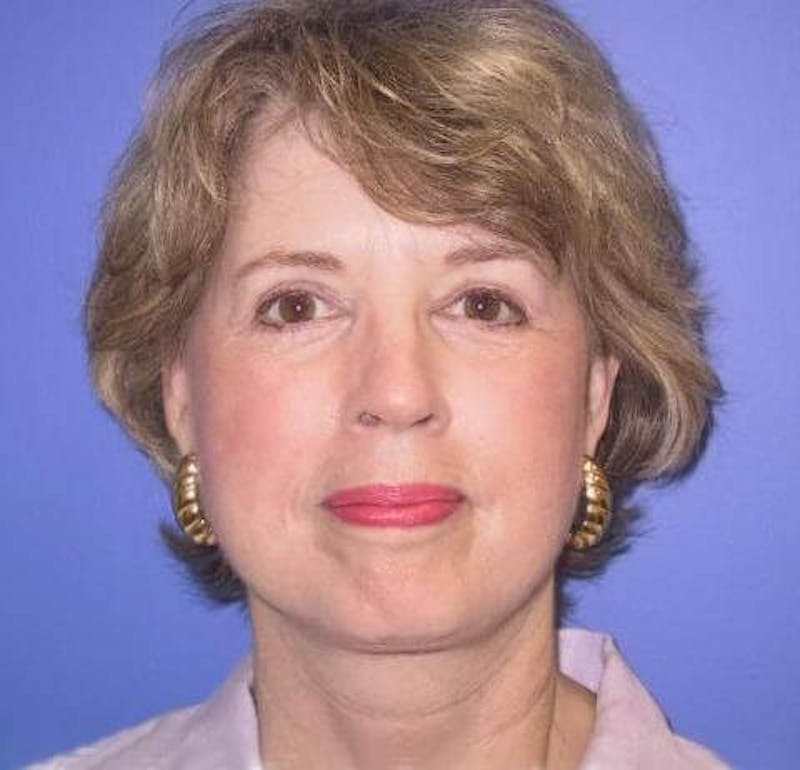 Neck Lift Before & After Gallery - Patient 91474246 - Image 4