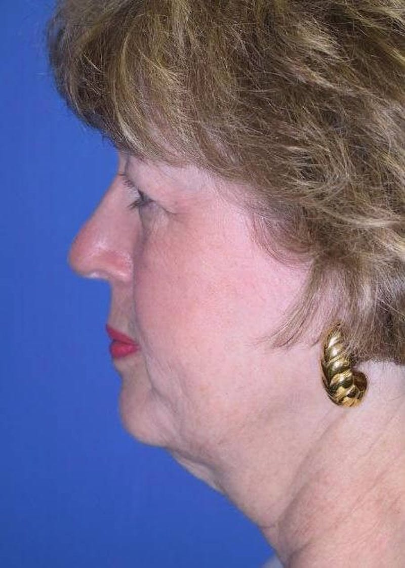 Neck Lift Before & After Gallery - Patient 91474246 - Image 5