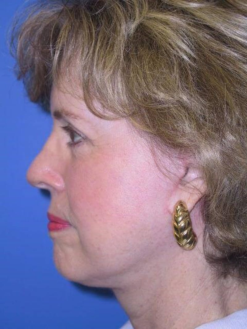 Neck Lift Before & After Gallery - Patient 91474246 - Image 6