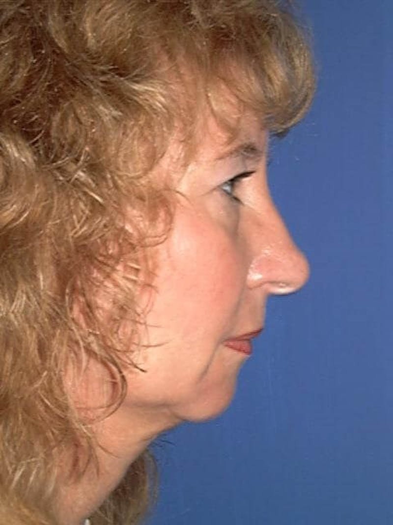 Neck Lift Before & After Gallery - Patient 91488891 - Image 3
