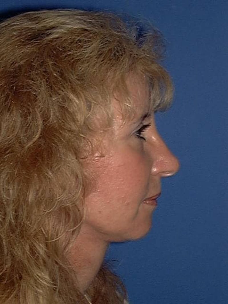 Neck Lift Before & After Gallery - Patient 91488891 - Image 6