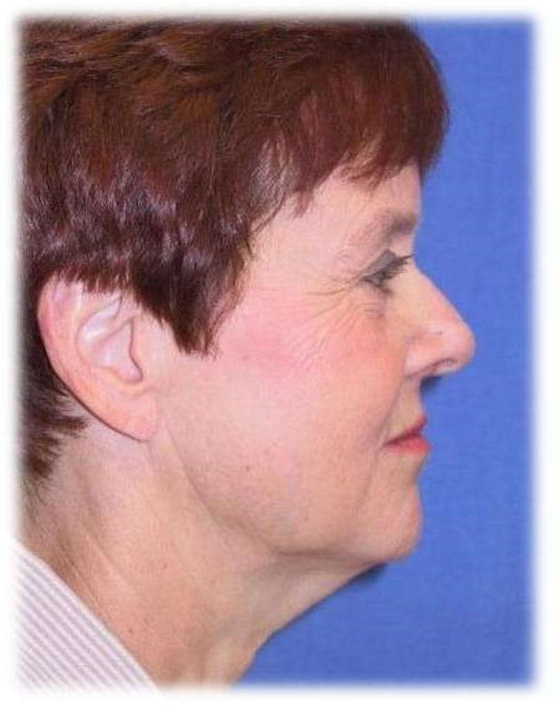 Neck Lift Before & After Gallery - Patient 91488918 - Image 3