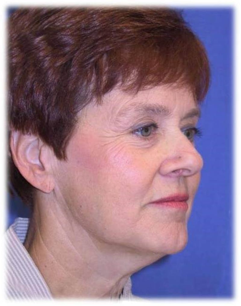Neck Lift Before & After Gallery - Patient 91488918 - Image 3