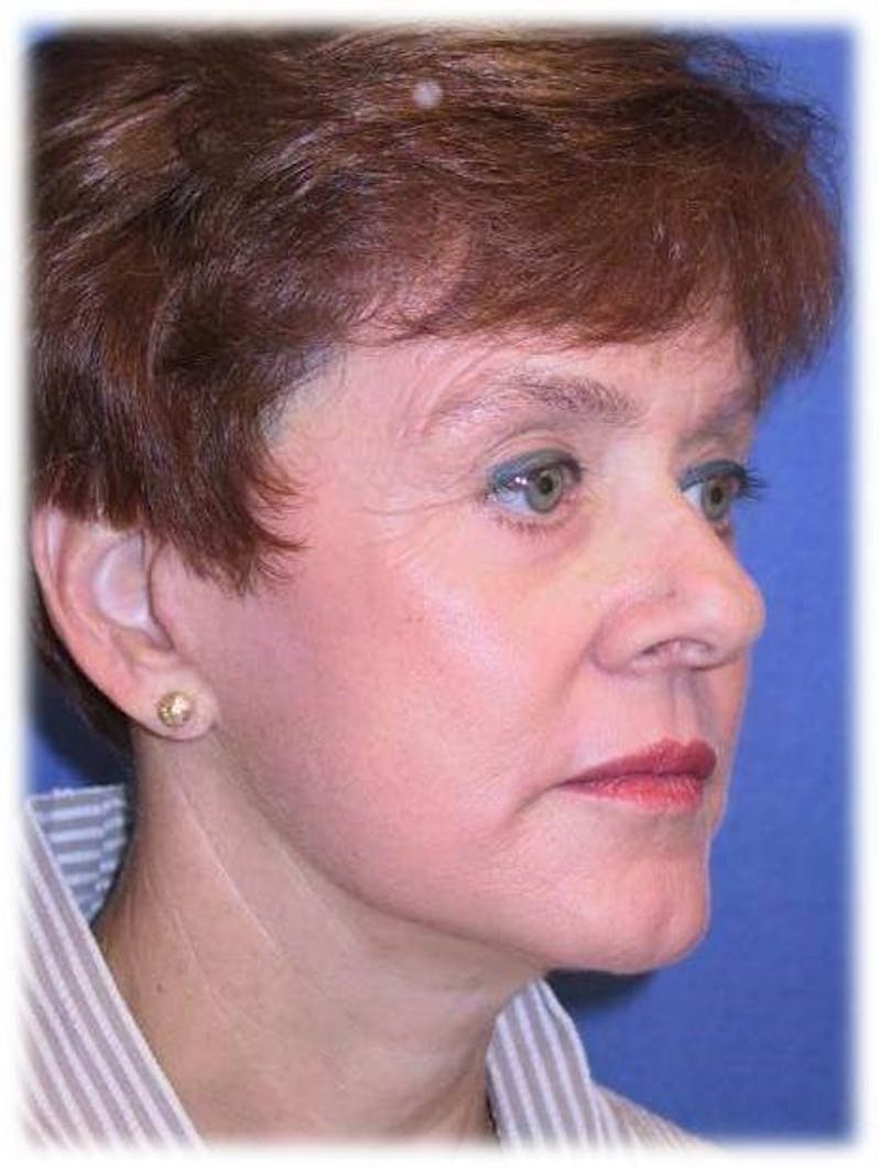 Neck Lift Before & After Gallery - Patient 91488918 - Image 4