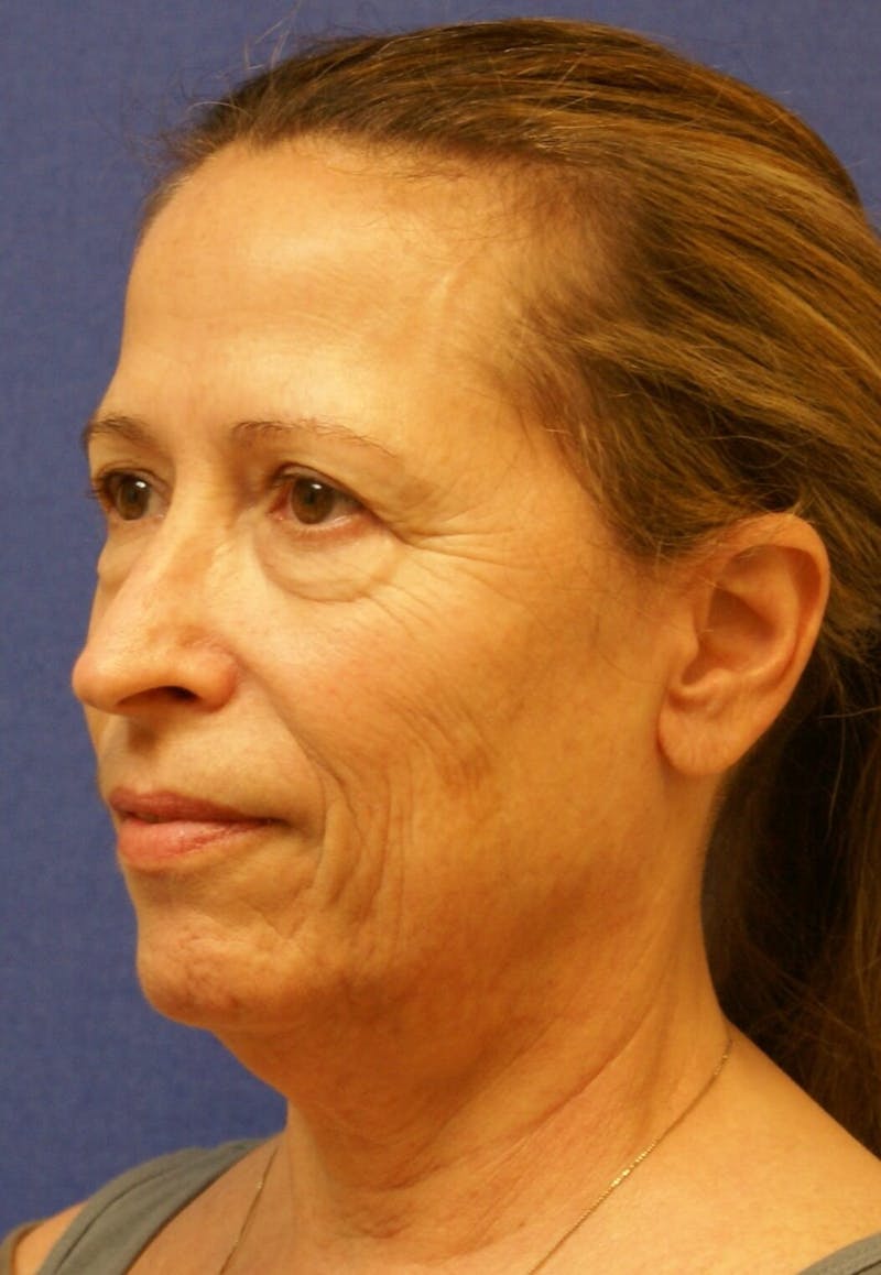 Neck Lift Before & After Gallery - Patient 91488933 - Image 3