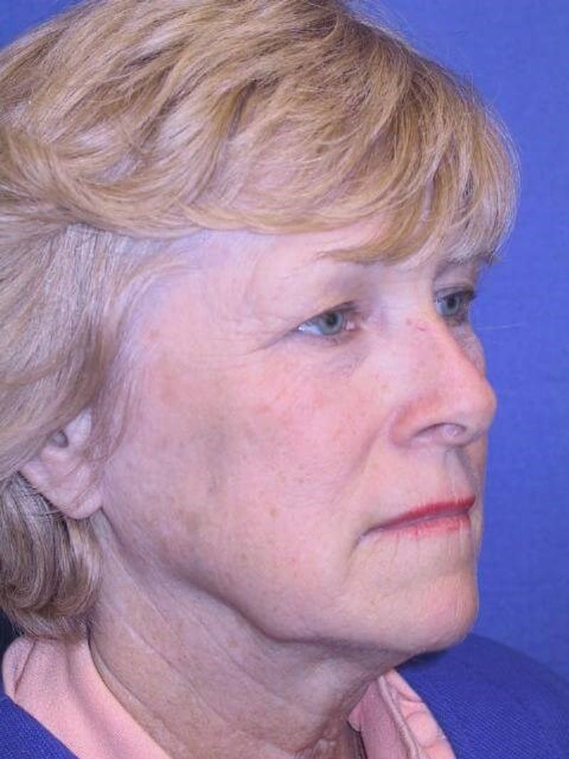 Neck Lift Before & After Gallery - Patient 91488941 - Image 1