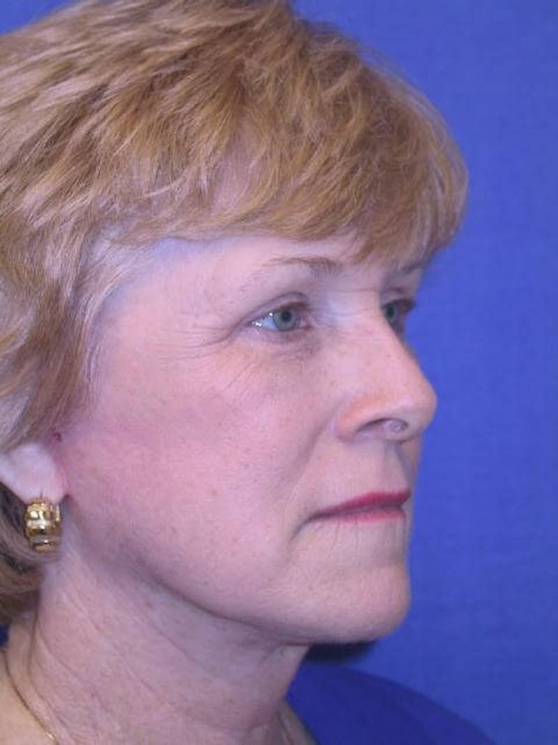 Neck Lift Before & After Gallery - Patient 91488941 - Image 4