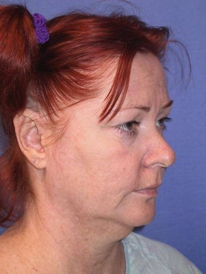 Neck Lift Before & After Gallery - Patient 91488943 - Image 3