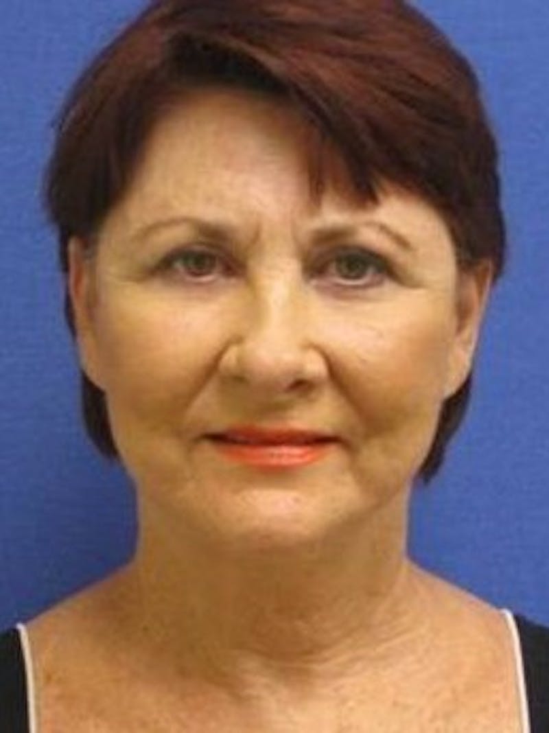 Neck Lift Before & After Gallery - Patient 91488946 - Image 2