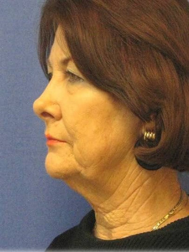 Neck Lift Before & After Gallery - Patient 91488946 - Image 3