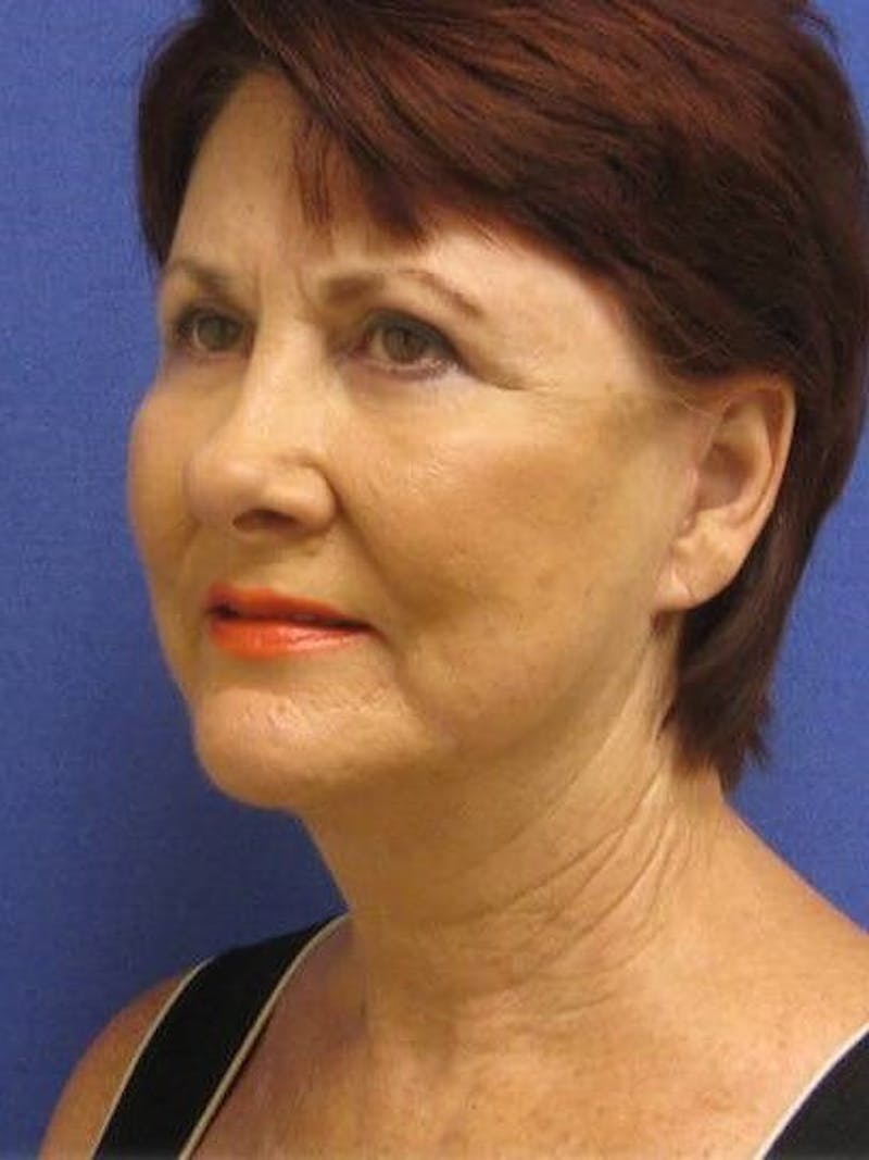 Neck Lift Before & After Gallery - Patient 91488946 - Image 4