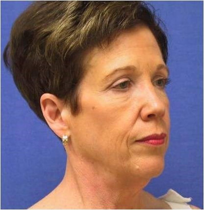 Neck Lift Before & After Gallery - Patient 91488948 - Image 1