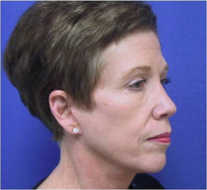 Neck Lift Before & After Gallery - Patient 91488948 - Image 2