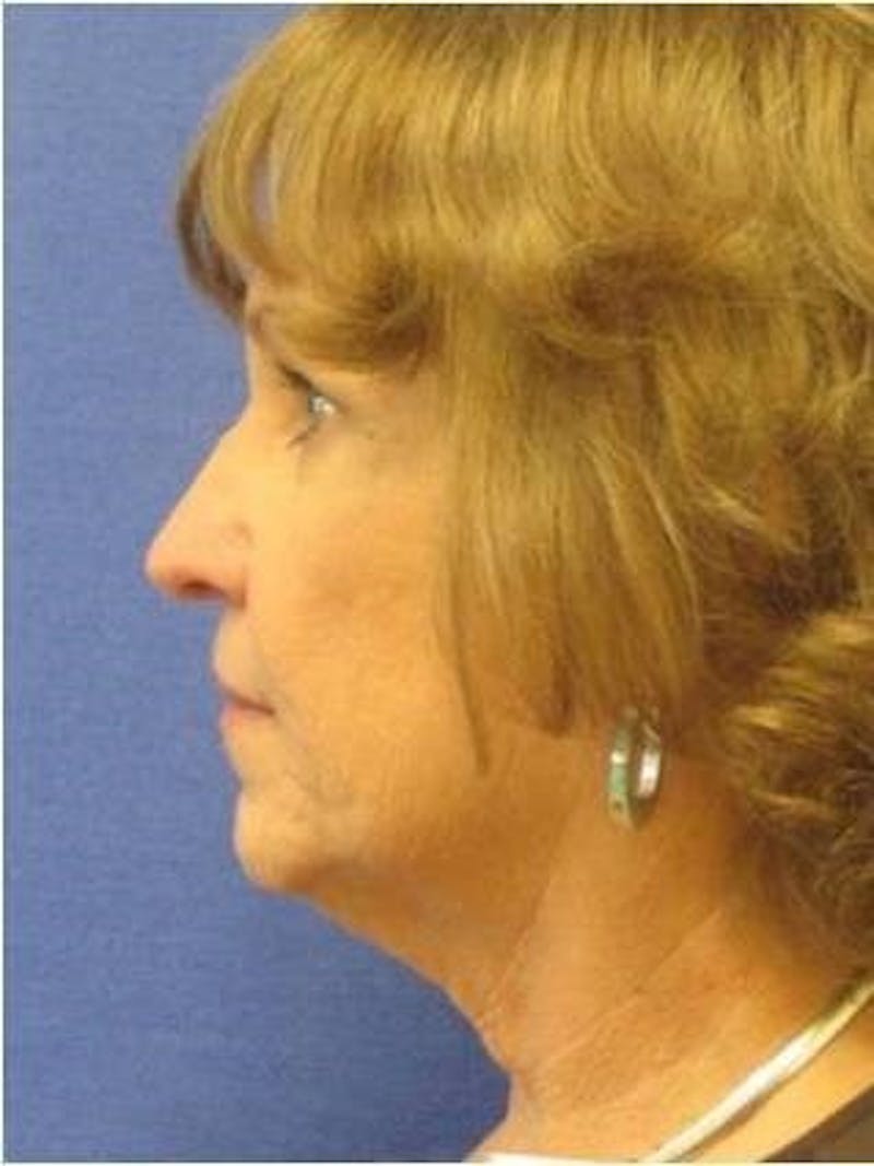 Neck Lift Before & After Gallery - Patient 91488950 - Image 1