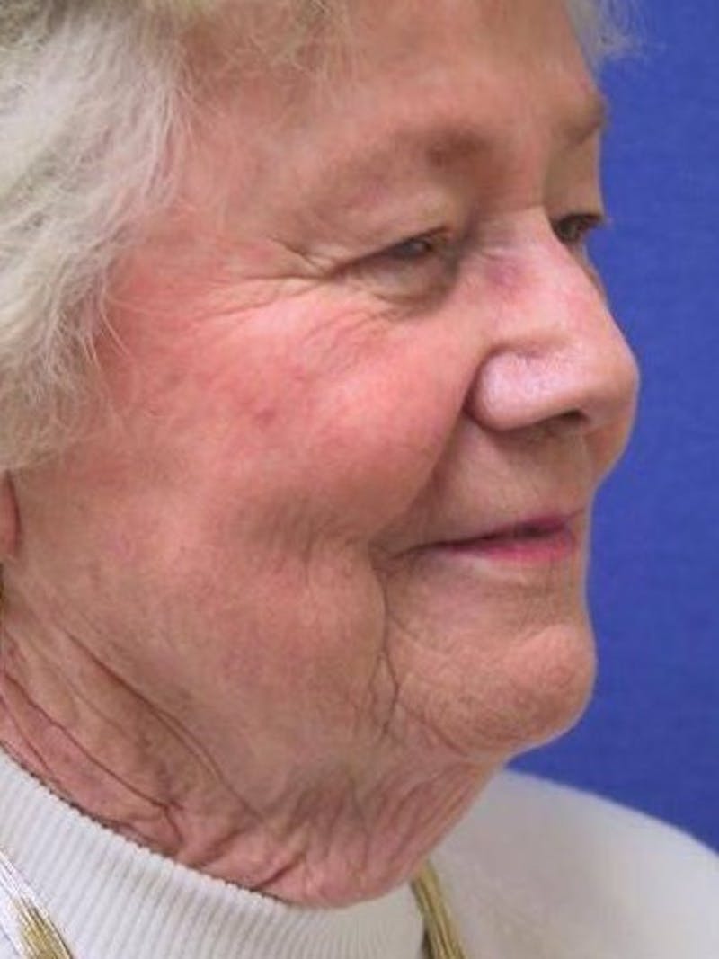 Neck Lift Before & After Gallery - Patient 91488951 - Image 3