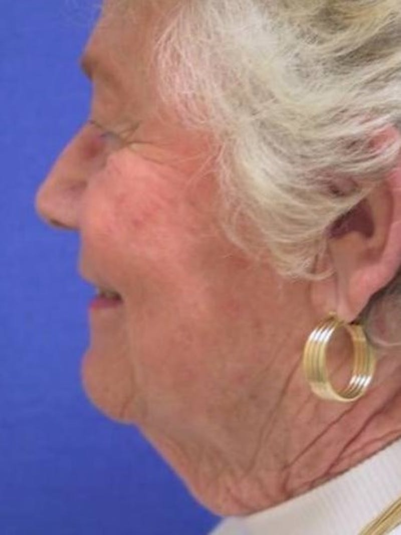 Neck Lift Before & After Gallery - Patient 91488951 - Image 5