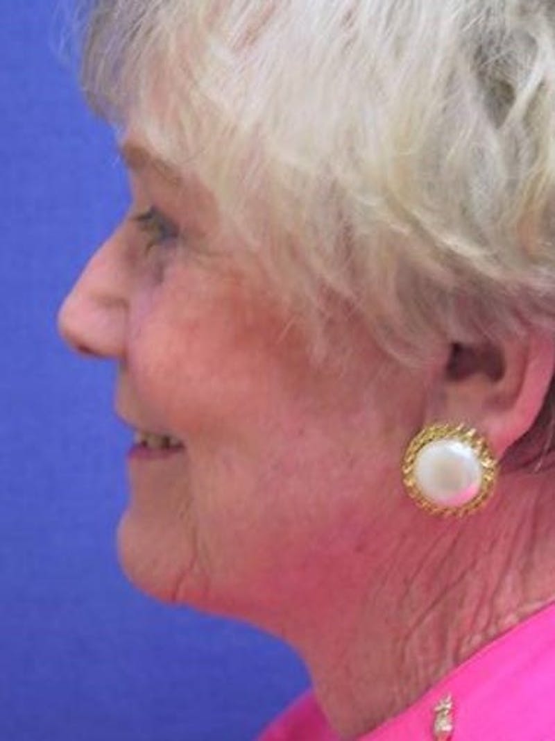 Neck Lift Before & After Gallery - Patient 91488951 - Image 6