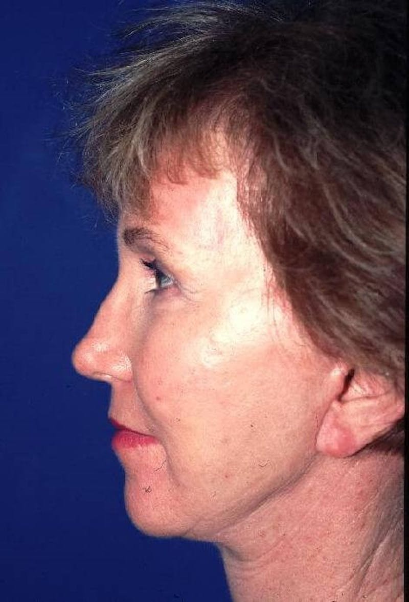 Neck Lift Before & After Gallery - Patient 91489333 - Image 6