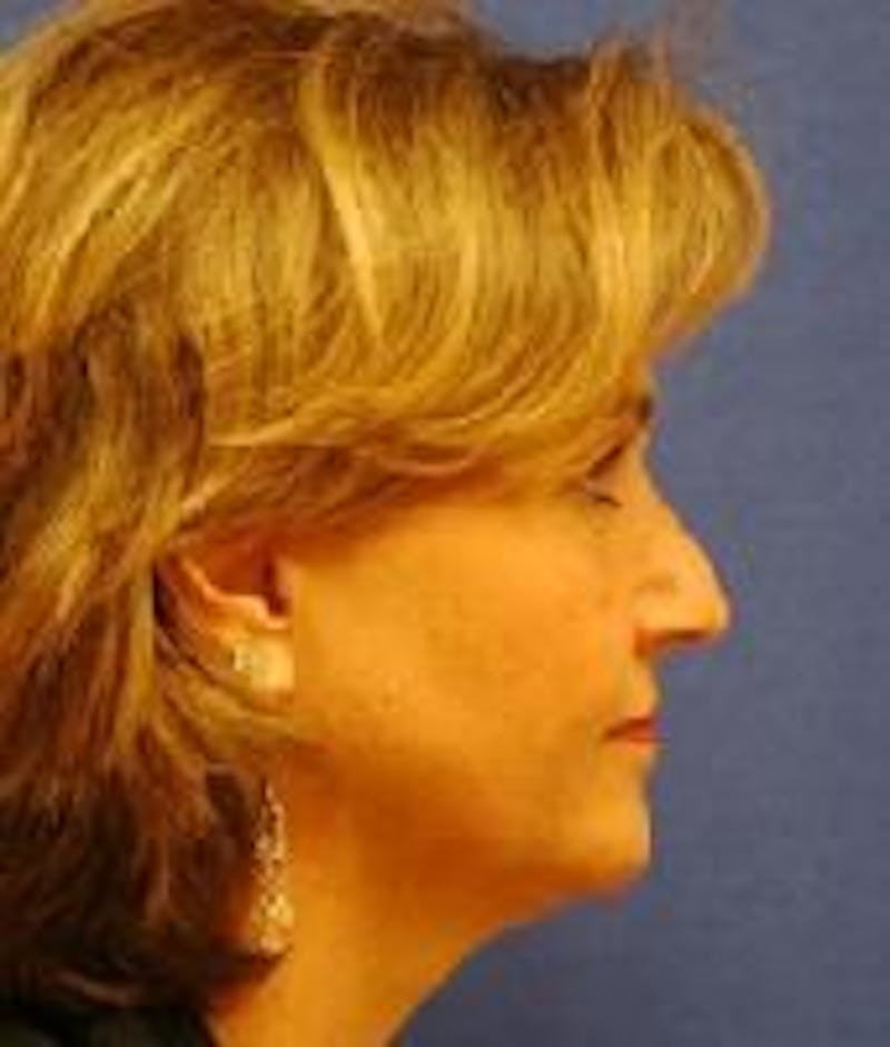 Neck Lift Before & After Gallery - Patient 91489335 - Image 5