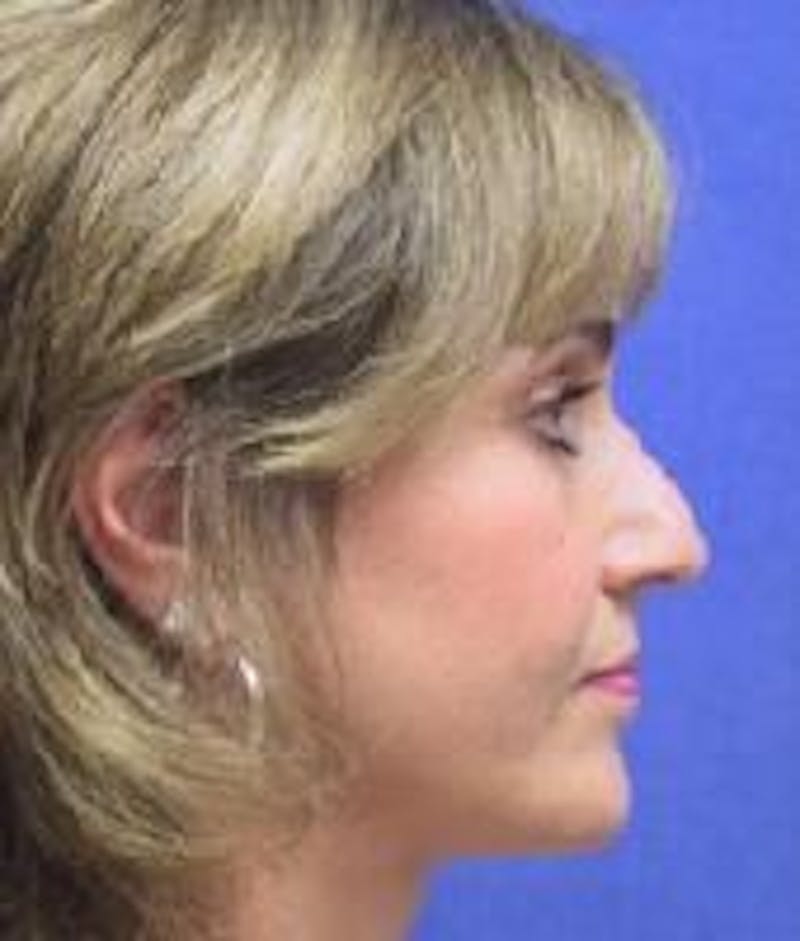 Neck Lift Before & After Gallery - Patient 91489335 - Image 6