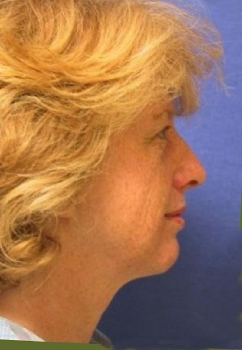 Neck Lift Before & After Gallery - Patient 91489339 - Image 3