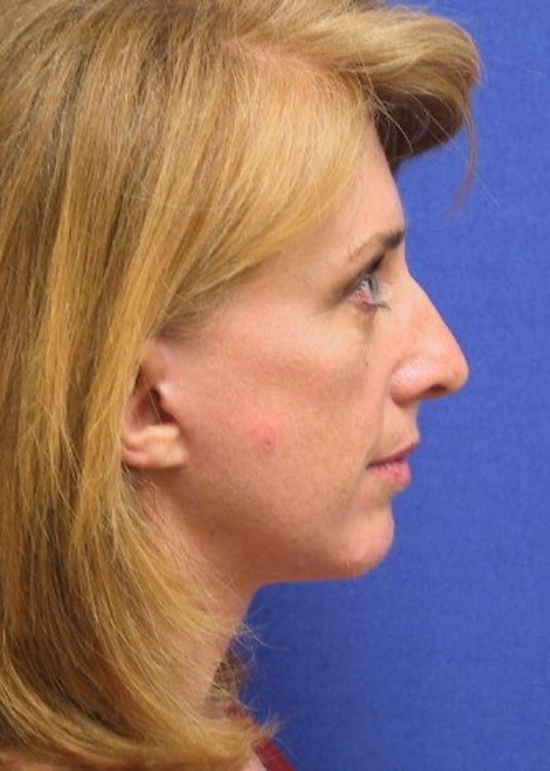 Neck Lift Before & After Gallery - Patient 91489339 - Image 4