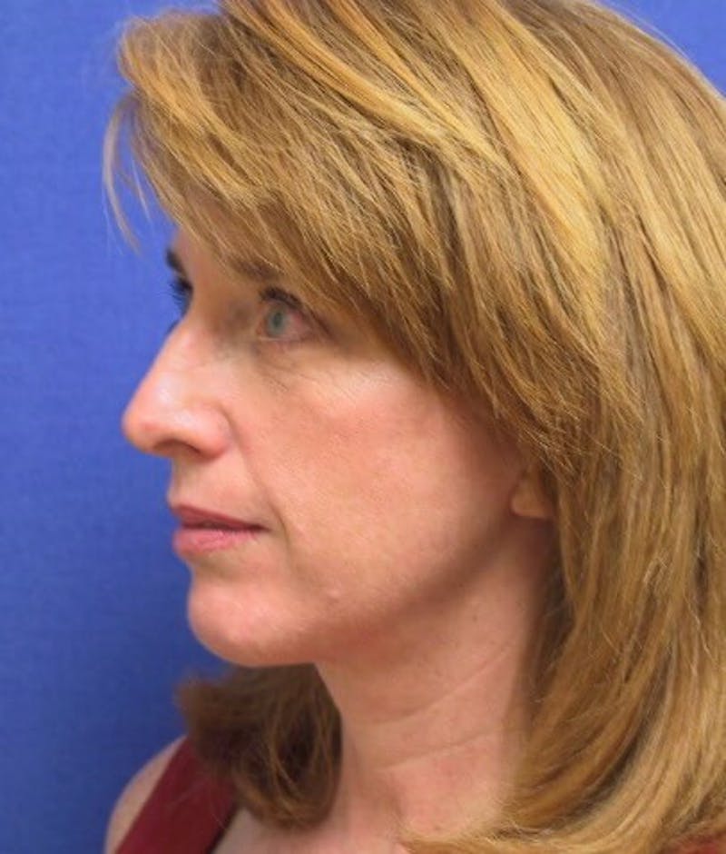Neck Lift Before & After Gallery - Patient 91489339 - Image 2