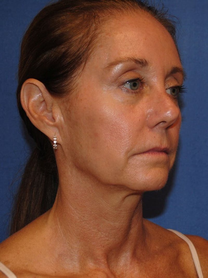 Neck Lift Before & After Gallery - Patient 91489341 - Image 5