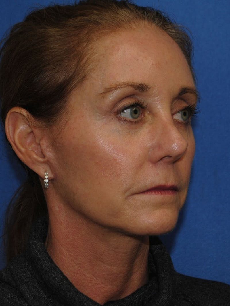 Neck Lift Before & After Gallery - Patient 91489341 - Image 2