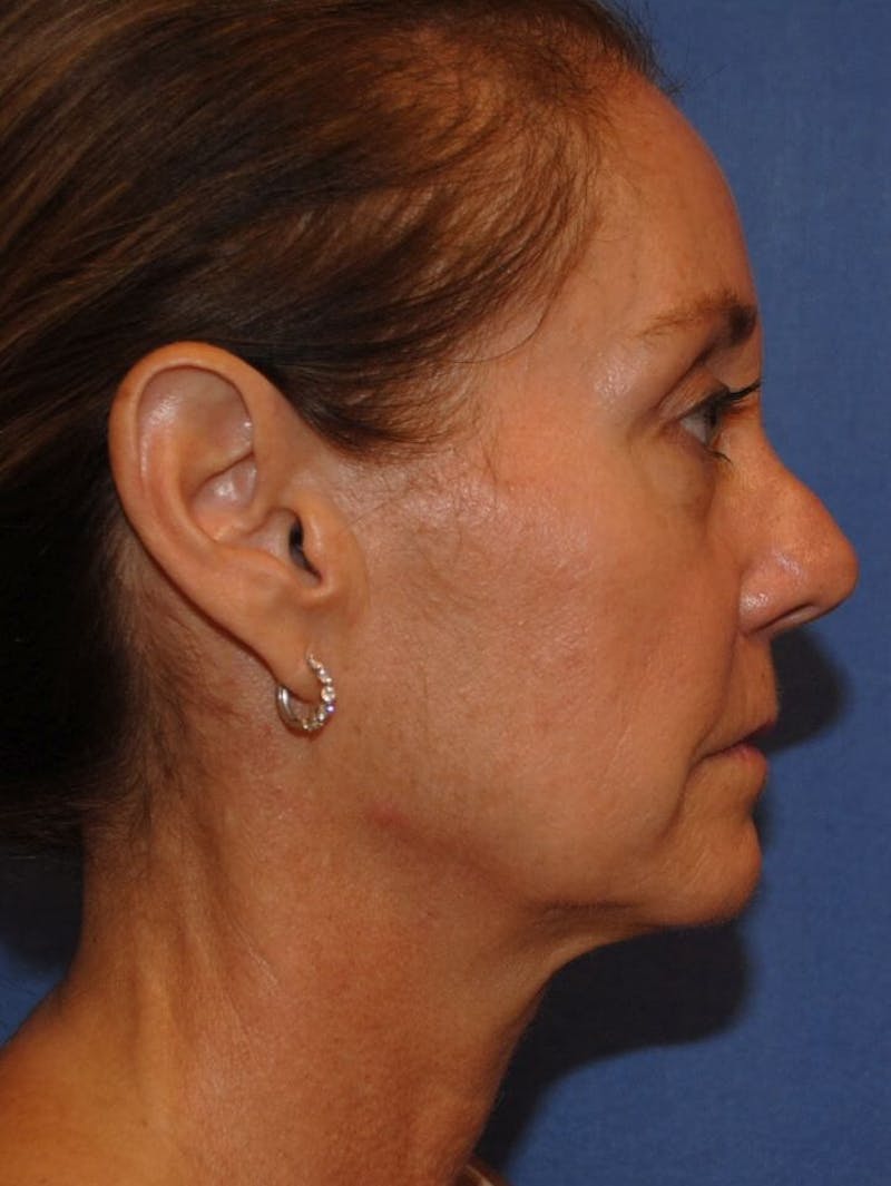 Neck Lift Before & After Gallery - Patient 91489341 - Image 5