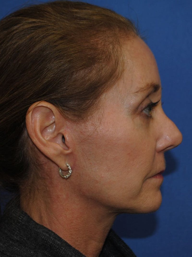 Neck Lift Before & After Gallery - Patient 91489341 - Image 8