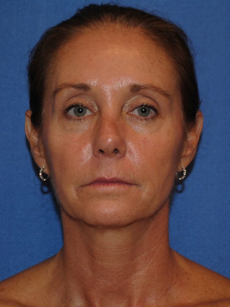 Neck Lift Before & After Gallery - Patient 91489341 - Image 9