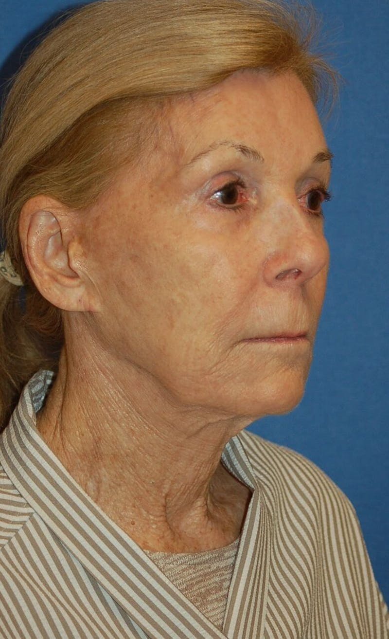 Neck Lift Before & After Gallery - Patient 91489342 - Image 3