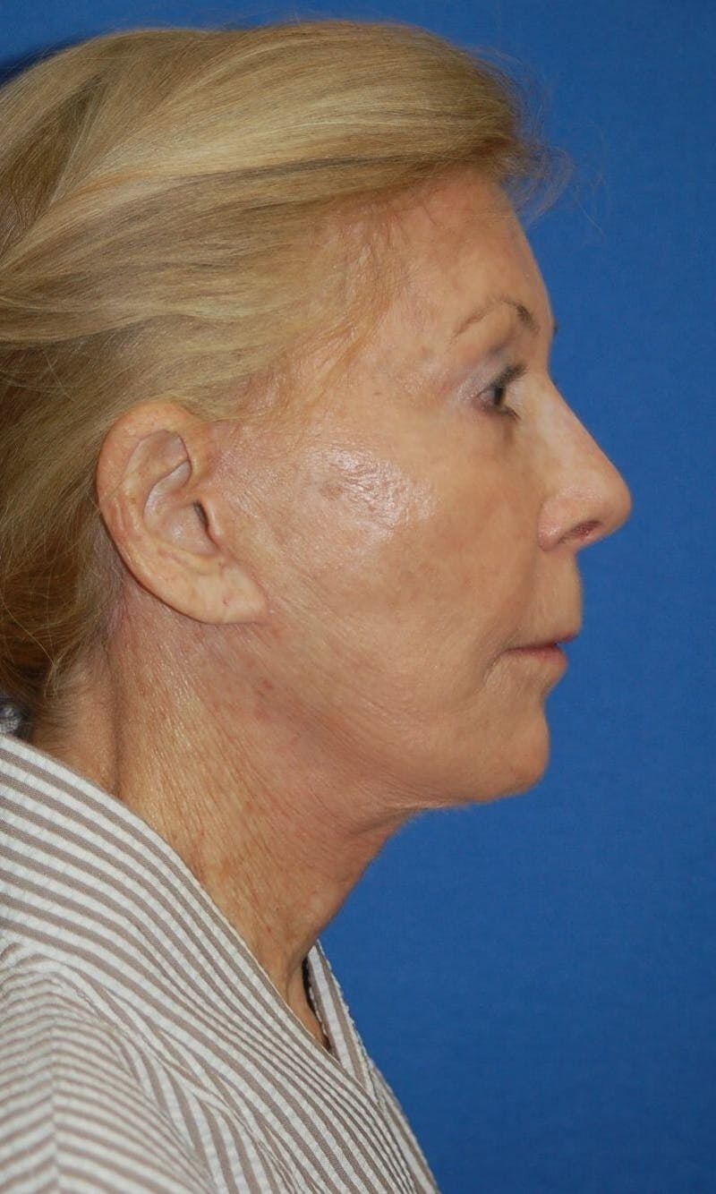 Neck Lift Before & After Gallery - Patient 91489342 - Image 5