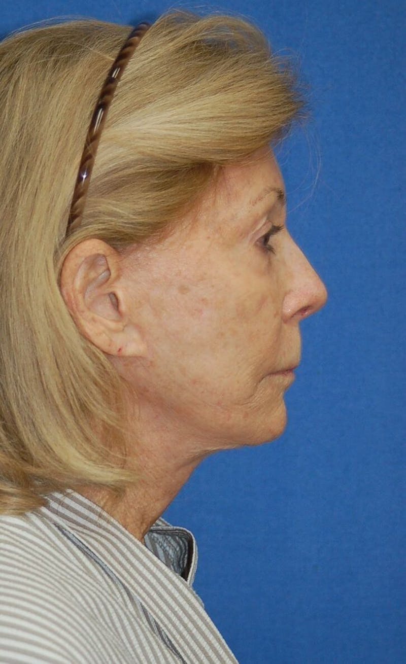 Neck Lift Before & After Gallery - Patient 91489342 - Image 6