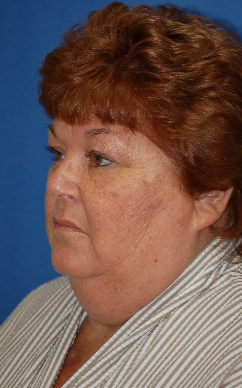 Neck Lift Before & After Gallery - Patient 91489347 - Image 3