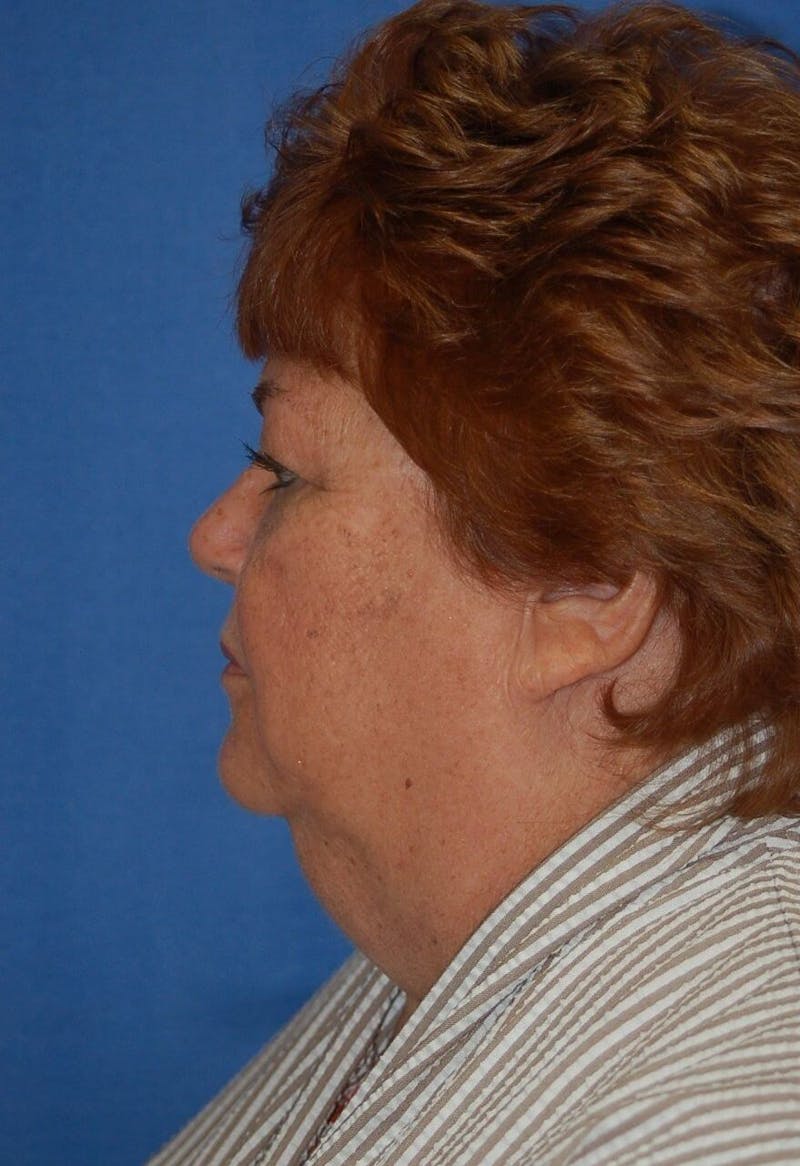 Neck Lift Before & After Gallery - Patient 91489347 - Image 5