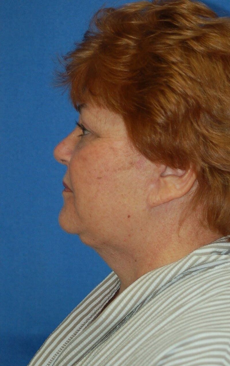 Neck Lift Before & After Gallery - Patient 91489347 - Image 6