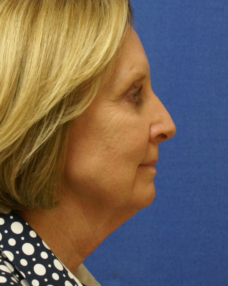 Neck Lift Before & After Gallery - Patient 91489348 - Image 3