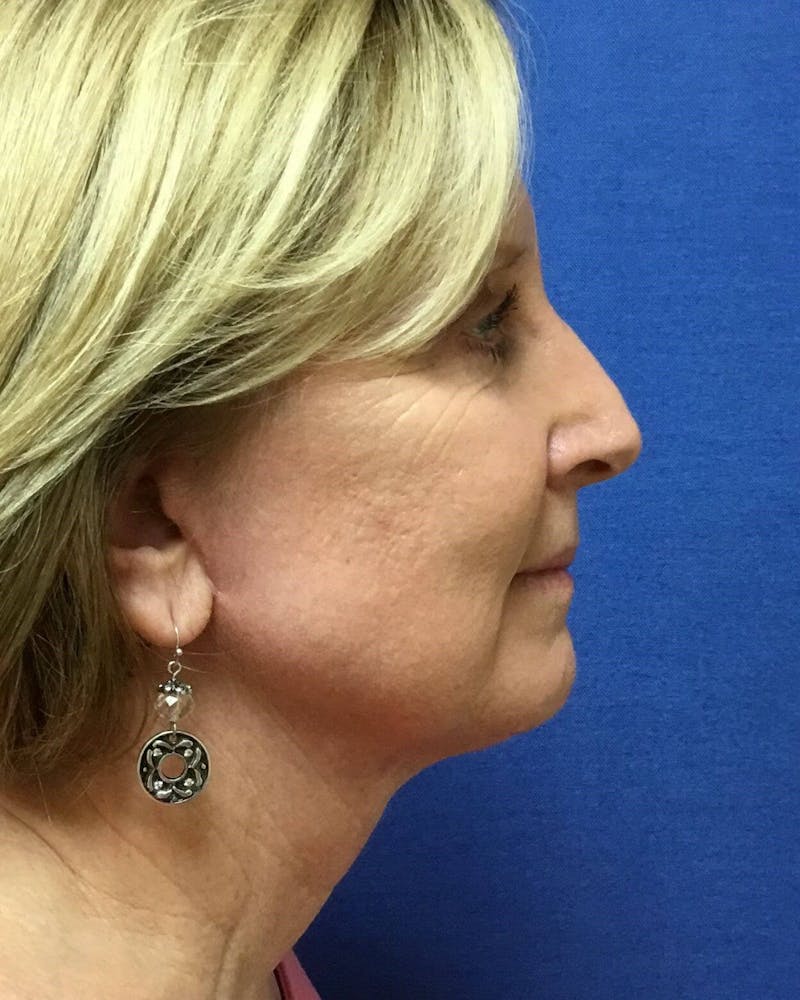 Neck Lift Before & After Gallery - Patient 91489348 - Image 6