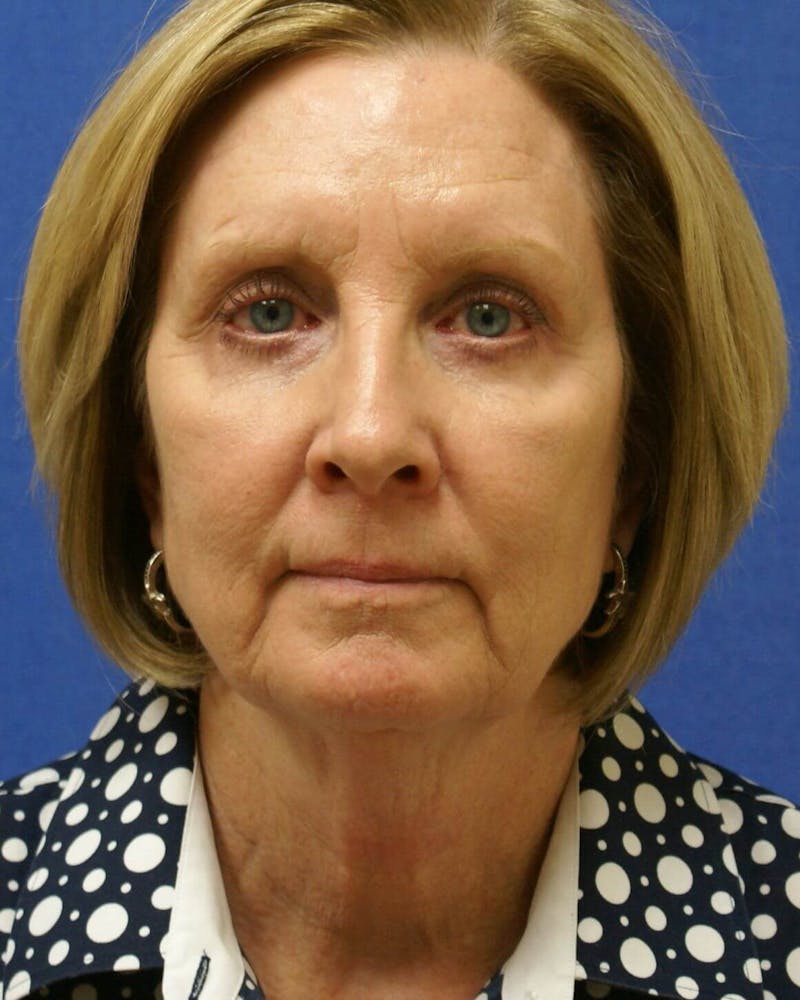 Neck Lift Before & After Gallery - Patient 91489348 - Image 1