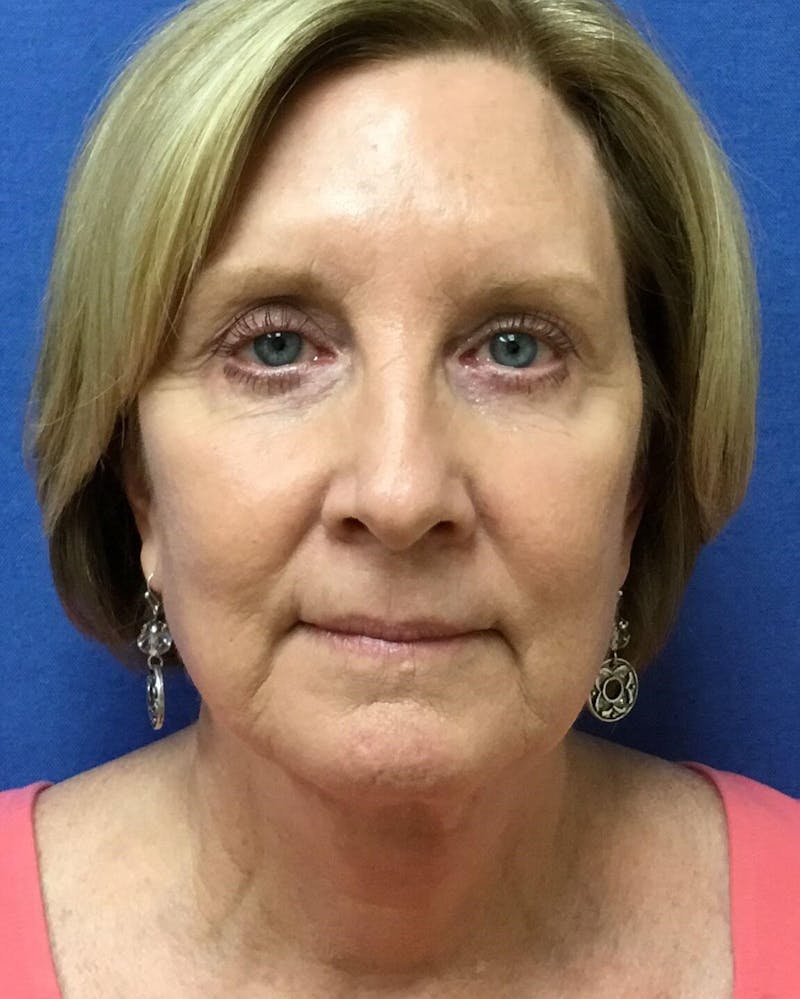 Neck Lift Before & After Gallery - Patient 91489348 - Image 2