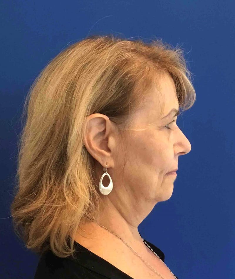 Neck Lift Before & After Gallery - Patient 91489352 - Image 5
