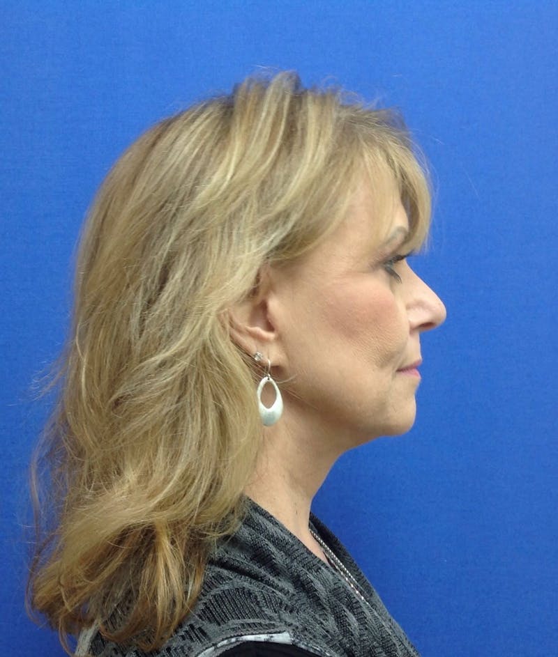 Neck Lift Before & After Gallery - Patient 91489352 - Image 6