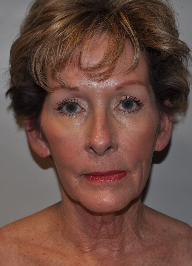 Neck Lift Before & After Gallery - Patient 91489353 - Image 1