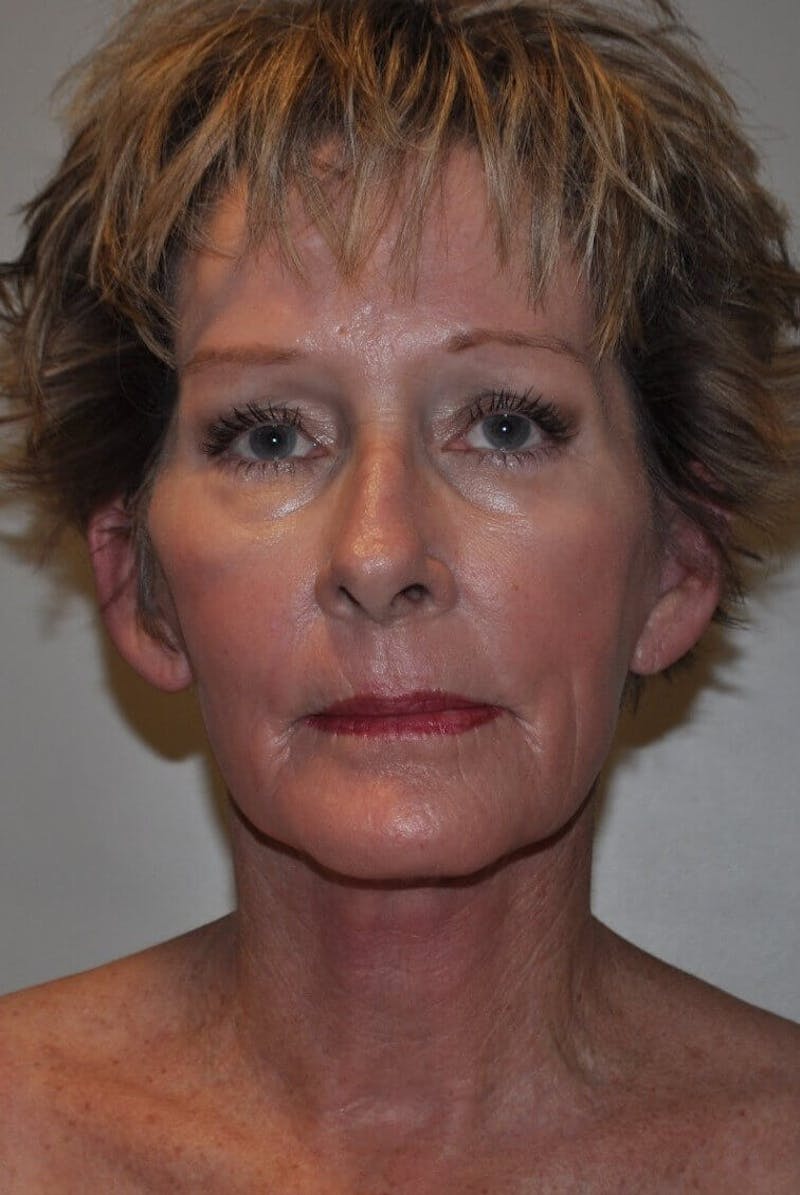 Neck Lift Before & After Gallery - Patient 91489353 - Image 2