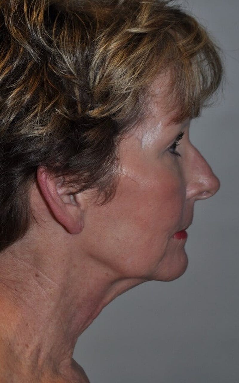 Neck Lift Before & After Gallery - Patient 91489353 - Image 3