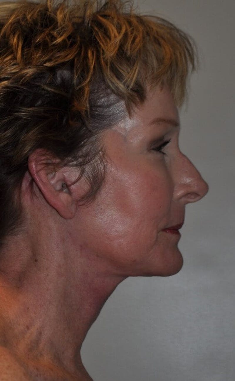 Neck Lift Before & After Gallery - Patient 91489353 - Image 4